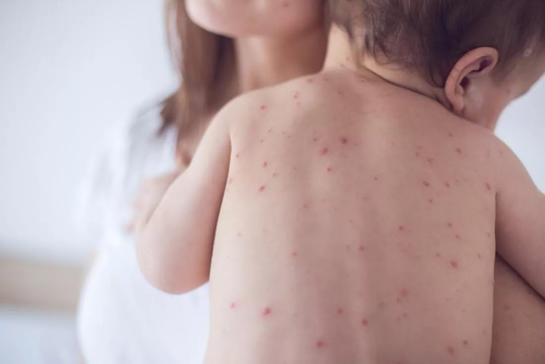 Clusters of measles cases have been reported in Cyprus, with a high risk of more cases emerging